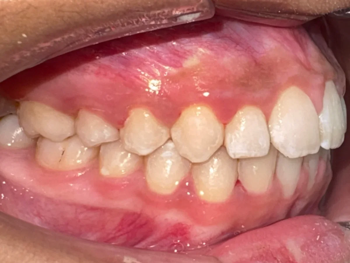 Después del tratamiento de apiñamiento dentario: resultado real en Clínica Beauty Line, La Serena