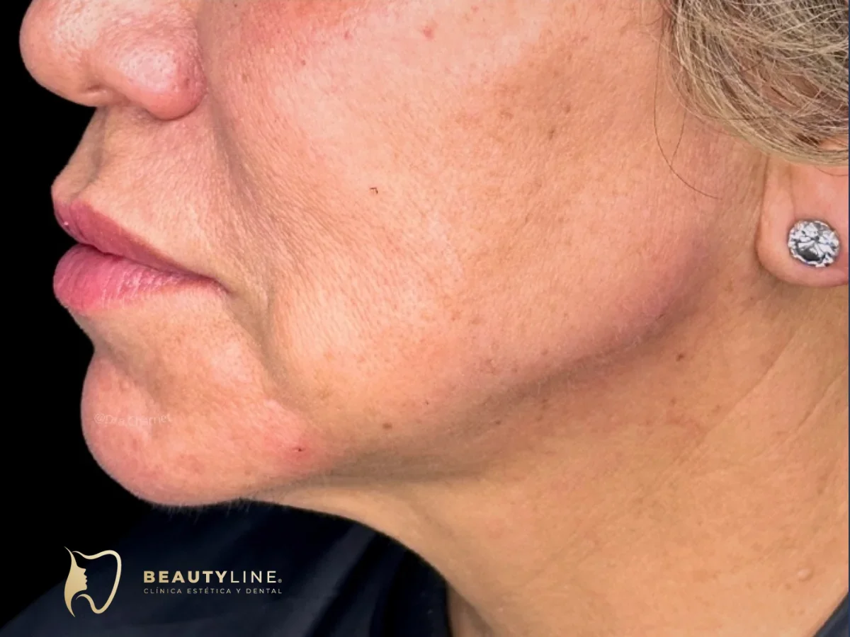 Después del marcado mandibular: resultado real en Clínica Beauty Line, La Serena