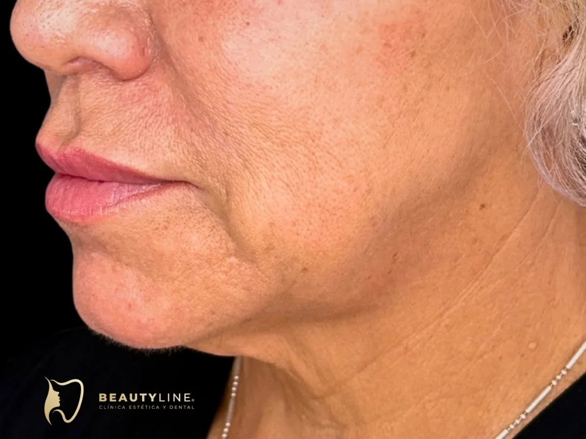 Antes del marcado mandibular en Clínica Beauty Line, La Serena